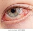 retina eye surgery